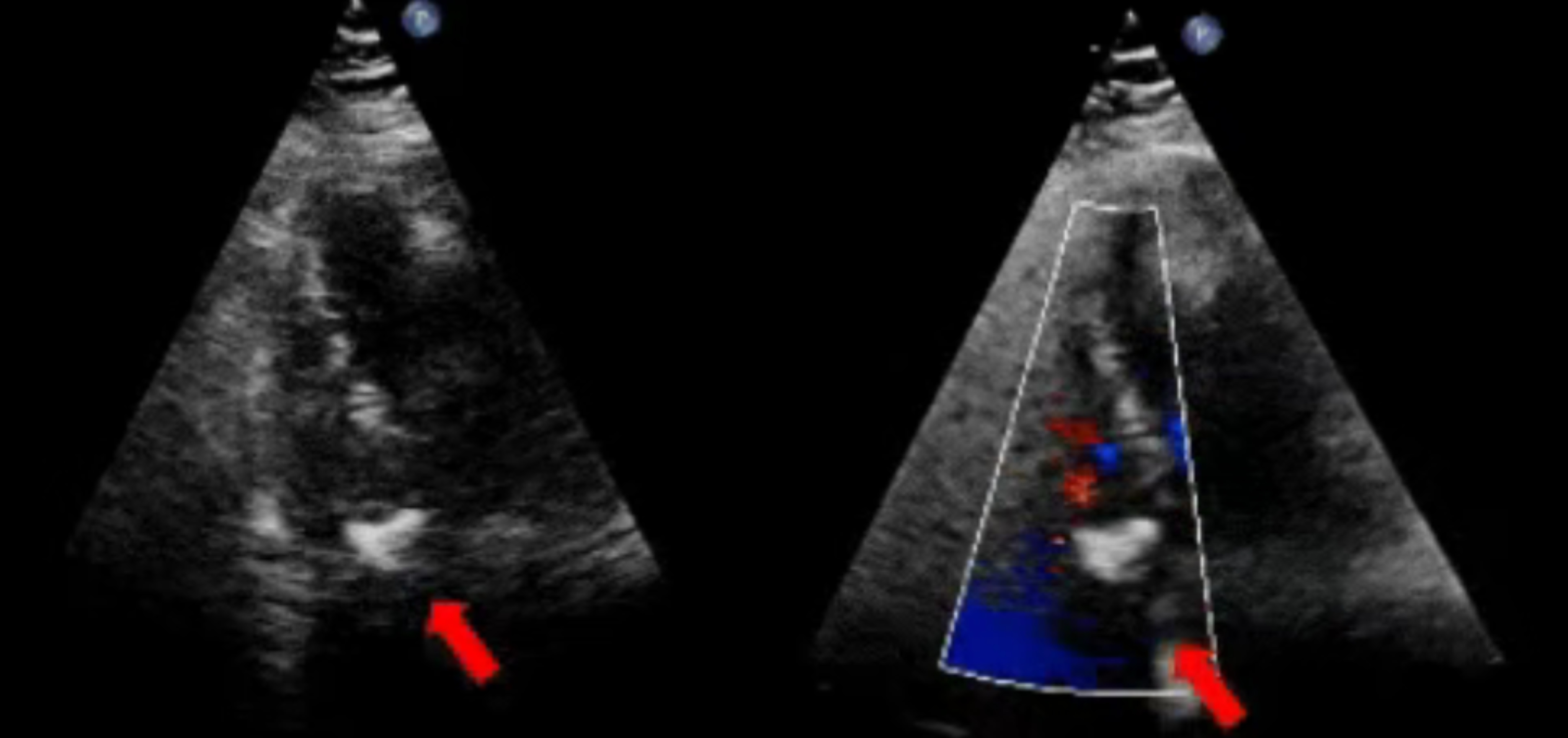 全球首例 | 主动脉窦瘤破裂全降解封堵器植入术！上海长海医院应用MemoSorb开创RSVA介入治疗新路径！