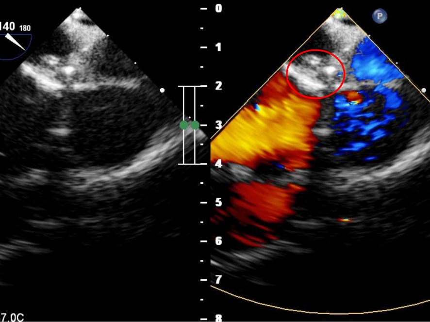 全球首例 | 左冠右房瘘全降解封堵成功！MemoSorb开创CCAF介入治疗新路径！