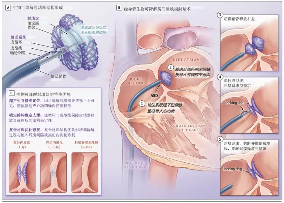 生物可降解封堵器临床应用的安全性考量：循证回顾与真实世界实践